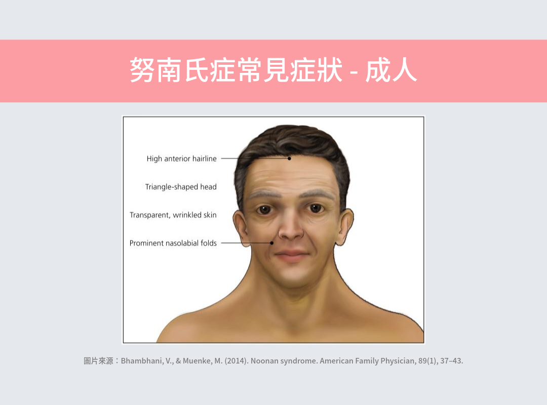 成人努南氏症常見症狀